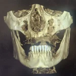 zigomaticni implantati primjeri pacijent 3 - kopjuterski snimak prije ugradnje