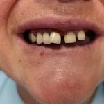 zigomaticni implantati primjeri pacijent 4 - prije