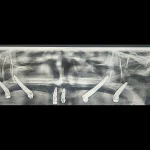 zigomaticni implantati primjeri pacijent 4 - rendgenski snimak