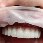 zigomaticni implantati primjeri pacijent 4 - rezultat 2