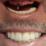 zigomaticni implantati primjeri pacijent 3 - kopjuterski snimak prije ugradnje