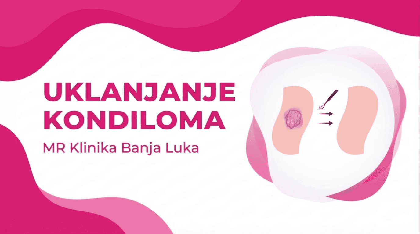 Kondilomi kod ena i Mukaraca  Uklanjanje Genitalnih Bradavica
