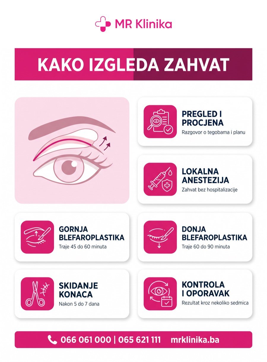 Kako izgleda zahvat blefaroplastike - tok operacije kapaka MR Klinika