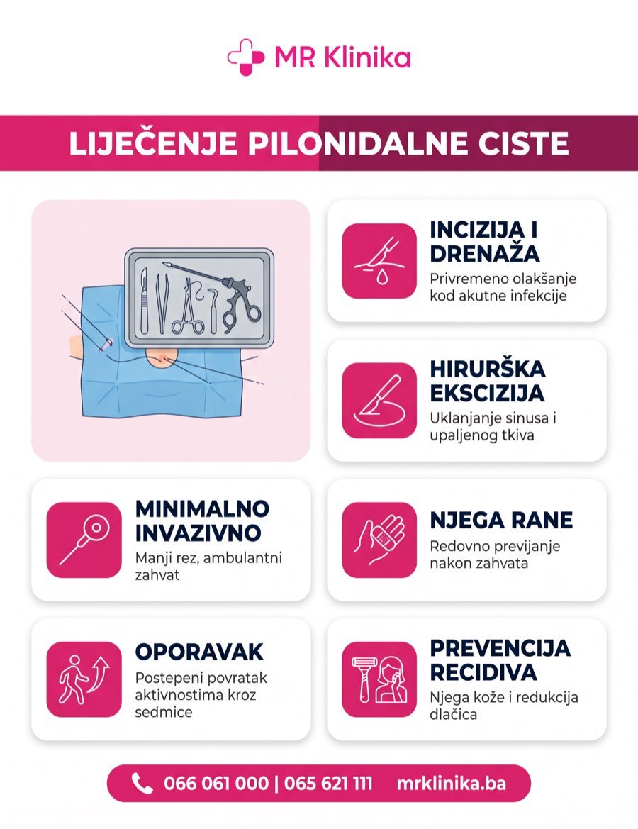 Liječenje pilonidalne ciste - incizija, ekscizija, minimalno invazivna metoda, njega rane