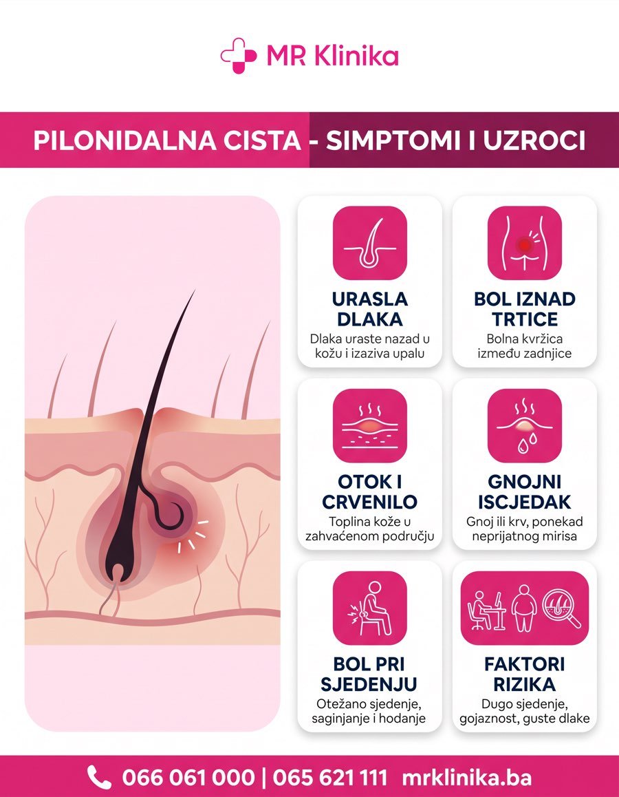 Pilonidalna cista simptomi - urasla dlaka, bol iznad trtice, otok, gnojni iscjedak