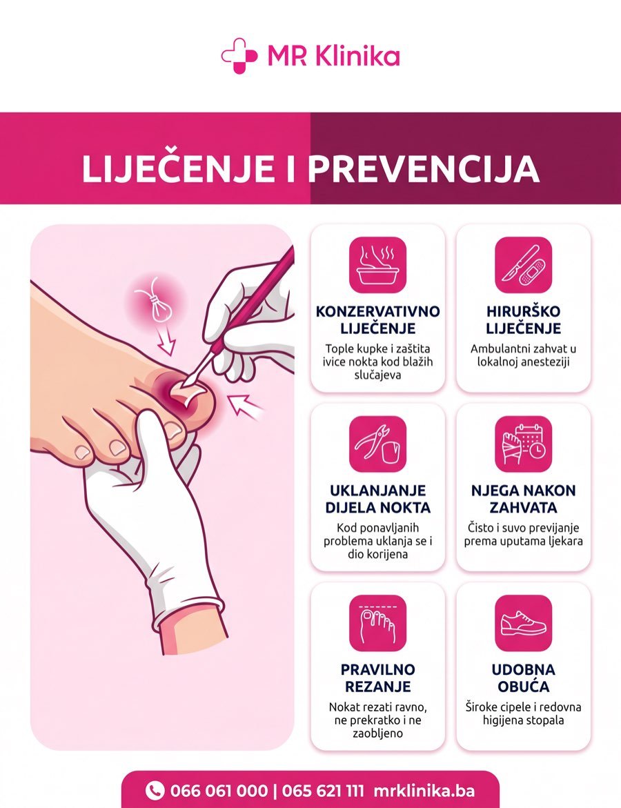 Liječenje i prevencija uraslog nokta infografika MR Klinika