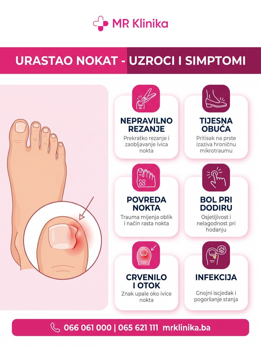 Urastao nokat - uzroci i simptomi infografika MR Klinika