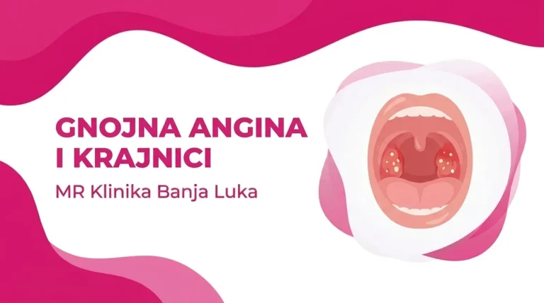 Gnojna angina - upaljeni krajnici sa gnojnim naslagama, ilustracija, MR Klinika Banja Luka