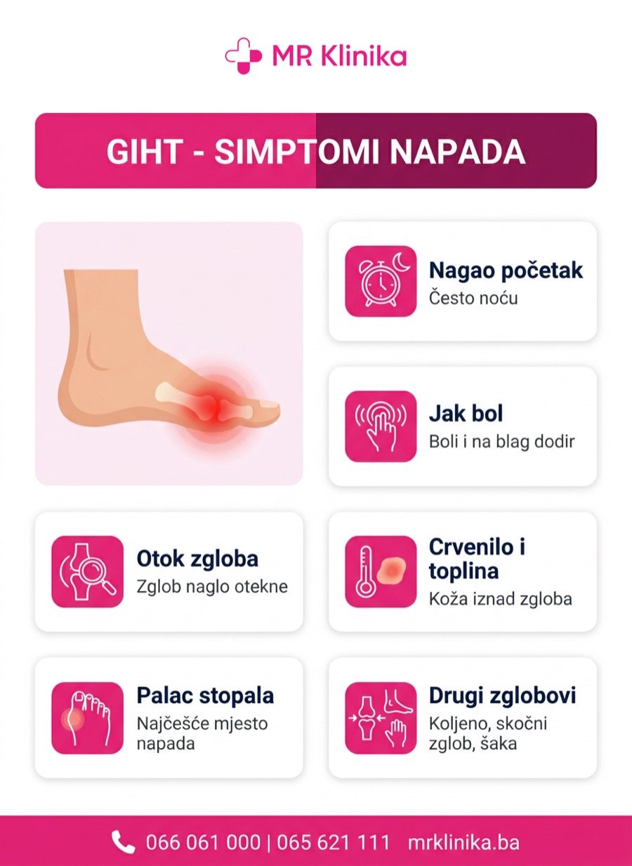Simptomi napada gihta - nagao bol, otok, crvenilo i toplina zgloba palca stopala