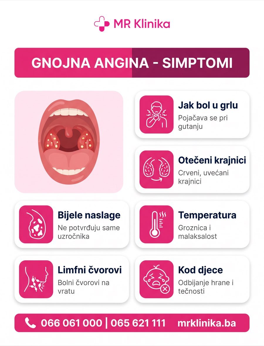 Gnojna angina - simptomi: jak bol u grlu, otečeni krajnici, bijele naslage, temperatura, limfni čvorovi i simptomi kod djece