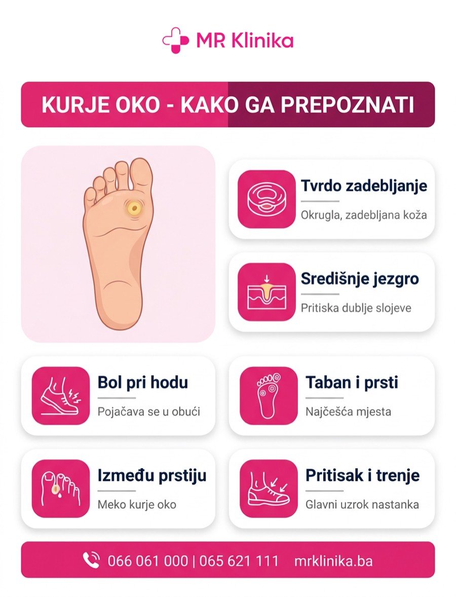 Kako prepoznati kurje oko - tvrdo zadebljanje sa središnjim jezgrom na tabanu i prstima