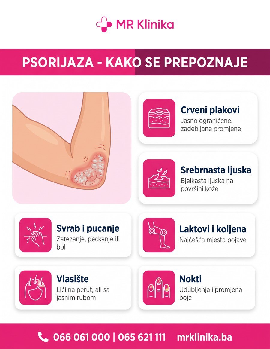 Psorijaza - kako se prepoznaje: crveni plakovi, srebrnasta ljuska, svrab, laktovi i koljena, vlasište i nokti